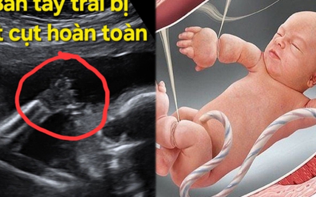 Thai nhi 21 tuần bị cắt cụt các ngón tay vì một thứ "sắc hơn dao" ngay trong bụng mẹ: Nguy hiểm nhưng khó phát
