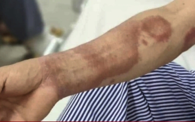 Ba năm mang 'chấm lạ', hai cha con đi khám mới biết mắc bệnh phong