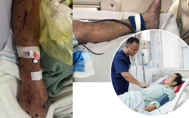 Người đàn ông ở Hưng Yên nguy kịch, tím toàn thân sau chế biến thịt lợn sống, bác sĩ khuyến cáo 3 không