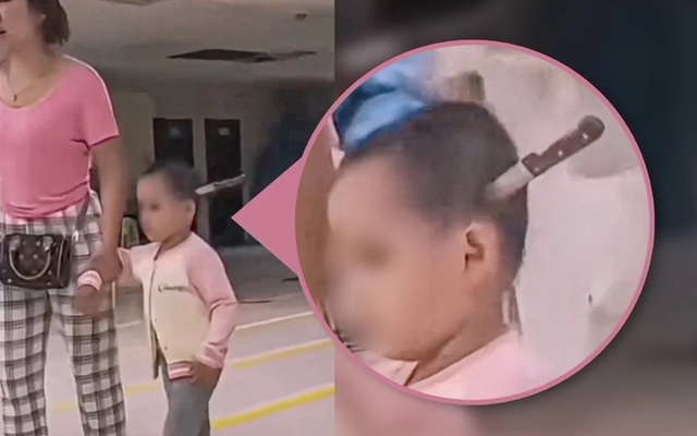 Bác sỹ kinh hãi khi bé gái 3 tuổi được mẹ dắt vào viện với con dao cắm vào đầu