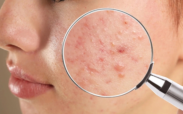 Ăn càng nhiều 5 thực phẩm này, đừng hỏi vì sao mụn "đua nhau" tìm đến