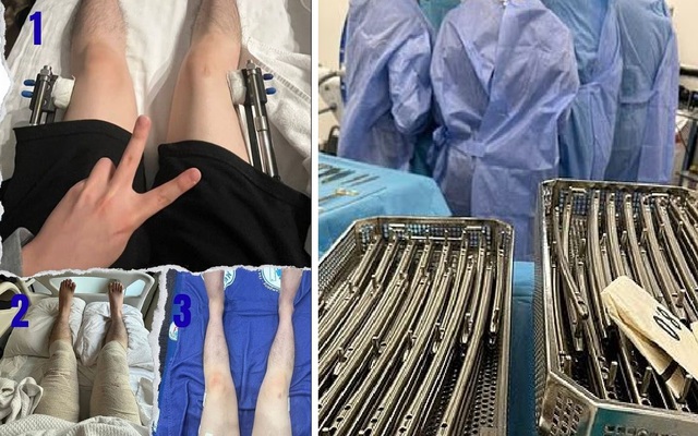 Những hình ảnh đáng sợ về thủ thuật kéo dài chân đang gây sốt toàn cầu