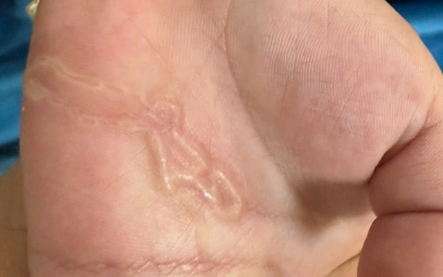 Bàn tay bé trai xuất hiện dấu hiệu lạ sau lần nghịch cát