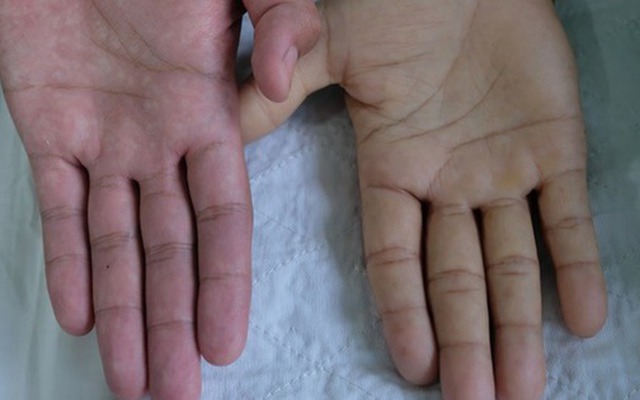 Một bệnh lý nguy hểm không chừa một ai: từ trẻ em, phụ nữ đến người làm văn phòng!