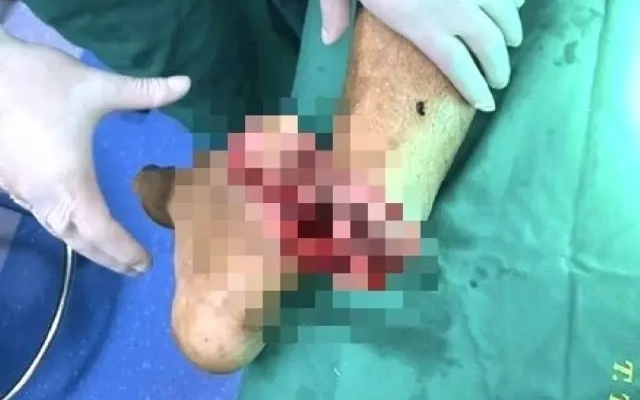 Bị chém gần đứt lìa chân khi mang hung khí đi tìm đối thủ