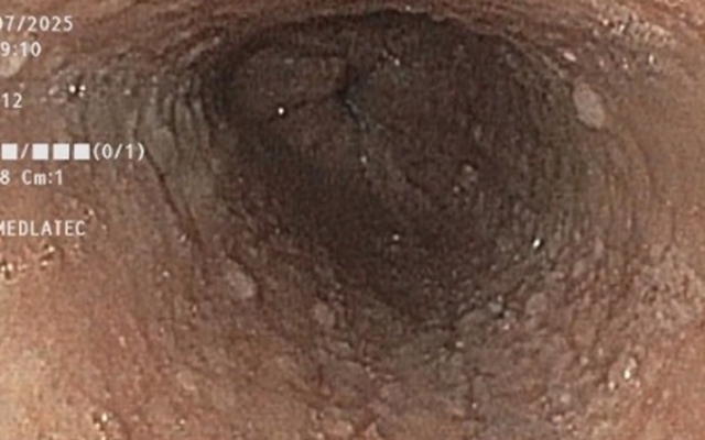 Người phụ nữ đi khám vì nuốt nghẹn, phát hiện 6 bệnh cùng lúc