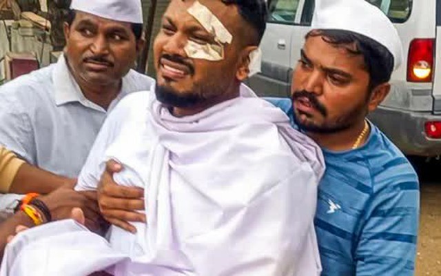 Tình hình hiện tại của người sống sót duy nhất trong thảm kịch máy bay Air India sau 3 tháng