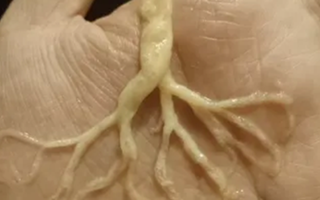 Người phụ nữ ho ra "rễ cây"