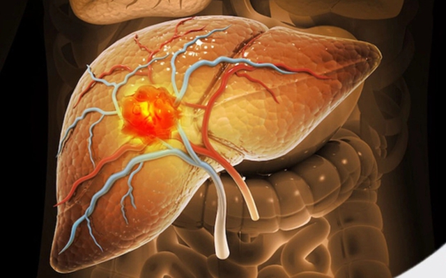 Ung thư gan rất "sợ" 7 loại thực phẩm này: Người trẻ càng nên chú ý