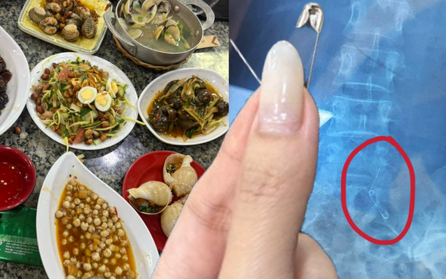 Đi ăn ốc, cô gái nuốt cả chiếc kim băng đang mở vào bụng, phải mổ cấp cứu 6 tiếng, tốn 70 triệu