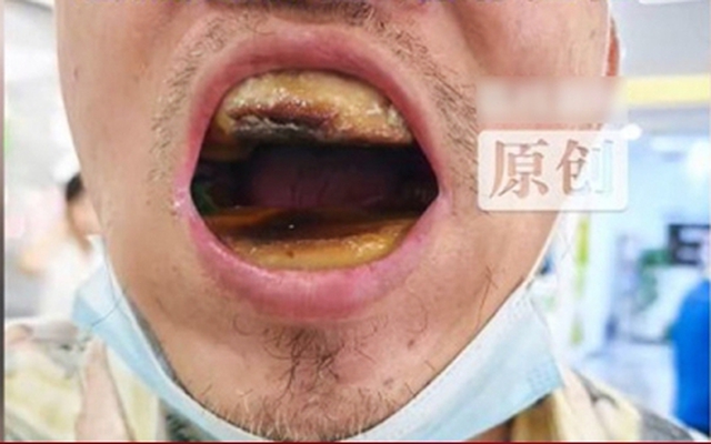 Hàm răng đáng sợ của người đàn ông tự mua nhựa về trám, nha sỹ bất lực