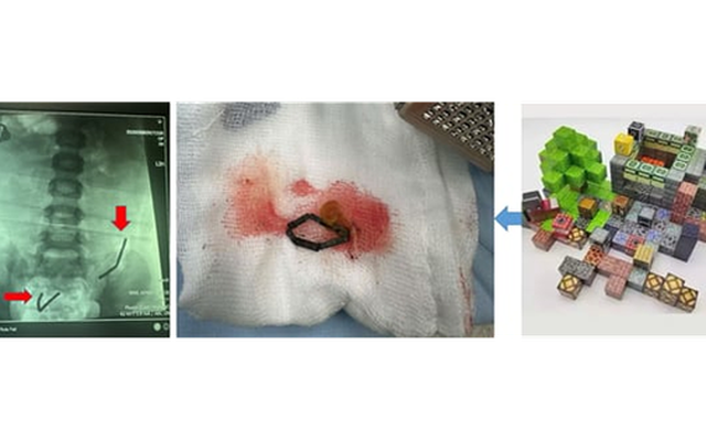Ớn lạnh phát hiện 20 viên nam châm rỉ sét nằm trong bụng bé trai