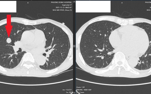 Ung thư lan khắp gan, phổi sau 6 tháng uống chanh muối để tự “chữa lành”
