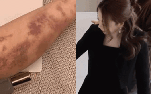 Sao nữ xinh như tiên tỉnh dậy hoảng loạn thấy toàn thân bầm tím sau khi tiêm thuốc bổ tại bệnh viện