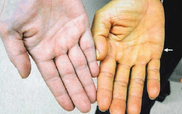 Siêu âm phát hiện nhiều người trẻ gan thô xù xì, nguyên nhân vì đâu?