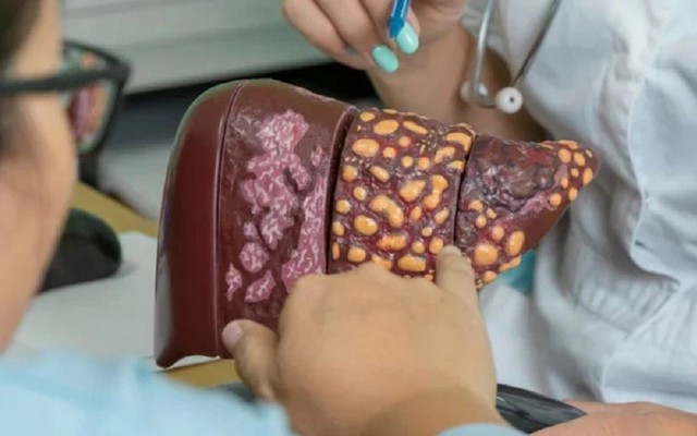 Không phải thể dục, chỉ cần 1 thay đổi trong lối sống có thể giảm 48% nguy cơ gan nhiễm mỡ, bệnh tim mạch và tử vong sớm