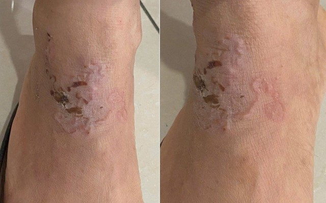 Sinh vật "đào đường hầm" ngoằn ngoèo dưới da người phụ nữ: Bác sĩ chỉ đích danh thủ phạm