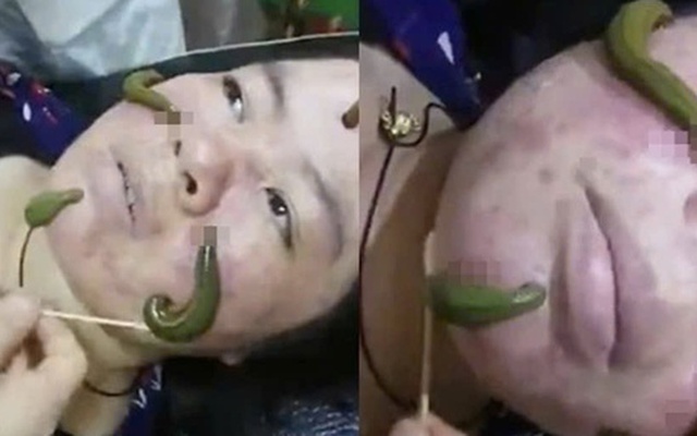 Ớn lạnh dùng đỉa hút mụn, bác sĩ cảnh báo hiểm họa