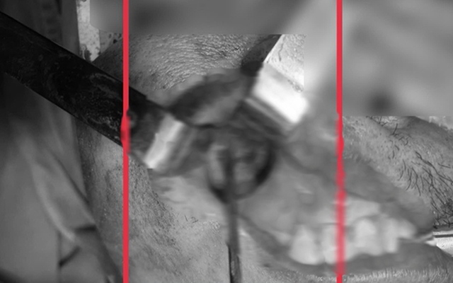 Nấm đen ăn mòn xoang hàm người đàn ông khỏe mạnh