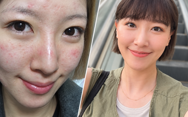 Nữ nghệ sĩ khổ sở vì bệnh da suốt 7 năm, sáng soi gương là bật khóc: Bác sĩ cảnh báo bệnh trứng cá đỏ không chỉ liên quan đến da mặt