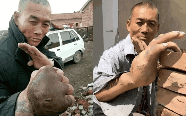 Nông dân Trung Quốc luyện Thiết Sa Chưởng 20 năm, bàn tay biến dạng như quái vật