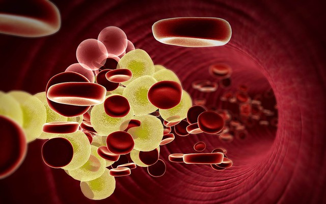 7 dấu hiệu của người có mỡ máu cao: Sau 40 tuổi nếu không có thì xin chúc mừng!