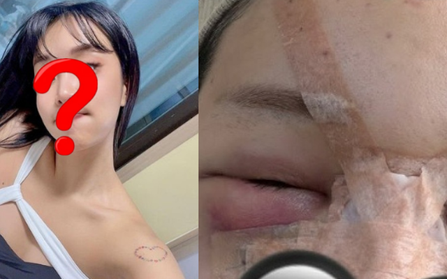 Trùng tu nhan sắc để ăn Tết, 1 sao nữ mặt mũi biến dạng, sưng phồng như bị "500 con ong đốt"