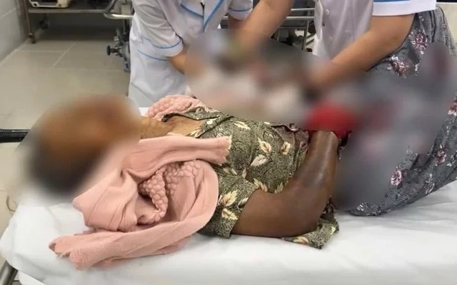 Tin lời chữa rắn cắn theo mẹo dân gian, người phụ nữ 76 tuổi nguy kịch: Sai lầm tai hại!
