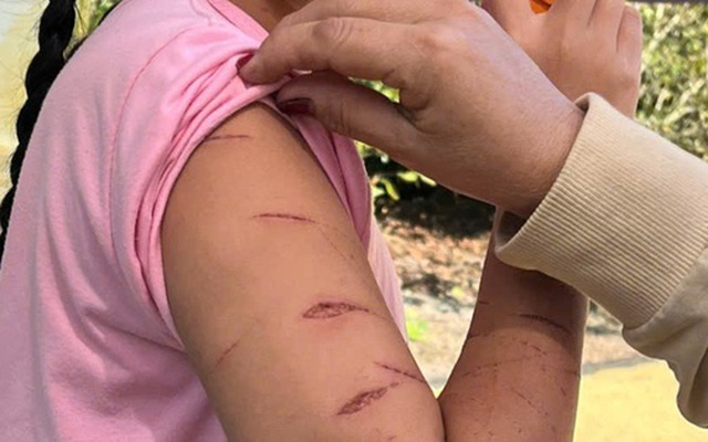 Nữ sinh lớp 5 ở Cà Mau bị người thân dùng dao cắt giấy gây thương tích