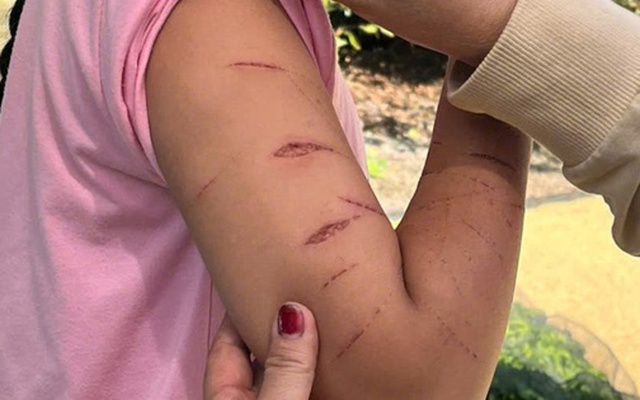 Chủ tịch UBND tỉnh Cà Màu chỉ đạo khẩn vụ nữ sinh lớp 5 bị gây thương tích