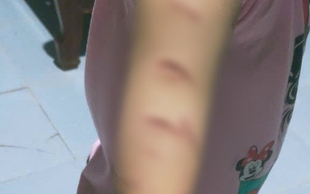 Vụ bé gái bị chị họ 12 tuổi dùng dao rạch khắp người: Mâu thuẫn từ việc em giật áo chị rủ chơi cùng