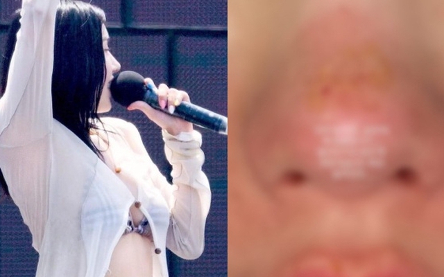 Nữ hoàng gợi cảm showbiz bị bỏng mặt, xót cho nhan sắc trời ban