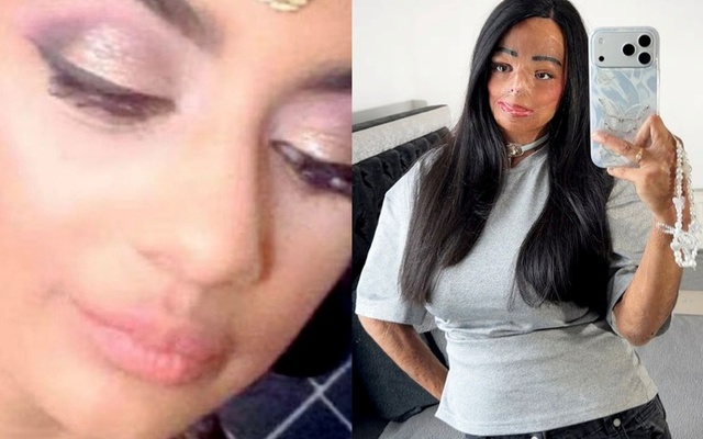 Dầu gội đầu trị chấy bắt lửa, thiếu nữ xinh đẹp bị bỏng nửa người và mất 7 ngón tay