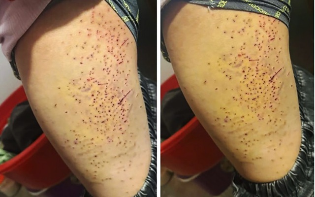 Nữ sinh lớp 7 dùng bút bi đâm hơn 20 lần vào đùi bạn học: Đây là nguyên nhân