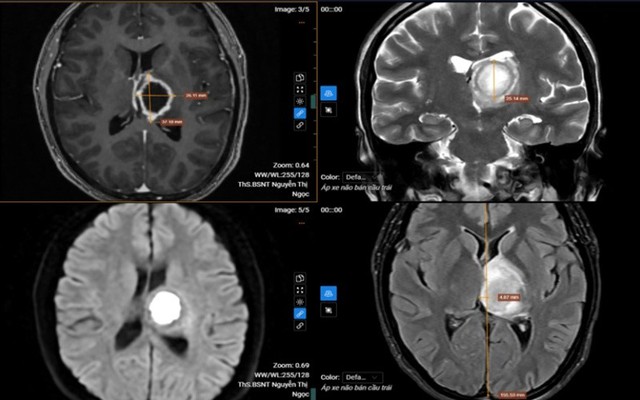 Thường xuyên buồn ngủ, đi khám “sốc” nặng khi biết nguyên nhân