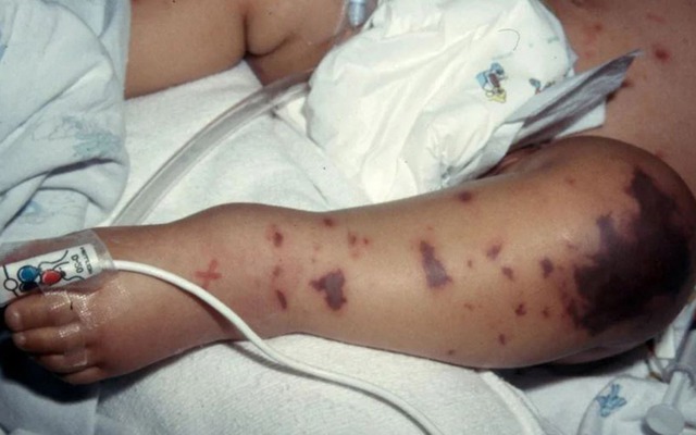 Liên tiếp ghi nhận ca mắc não mô cầu, nhận diện sớm dấu hiệu điển hình