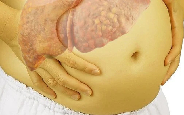 Nhiều người Việt xơ gan, ung thư gan chỉ vì dùng 1 thứ tưởng "lành tính": Bác sĩ cảnh báo