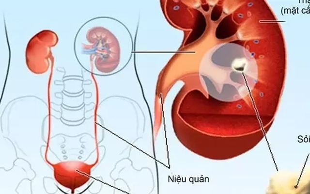 Cách phòng ngừa sỏi thận không dùng thuốc