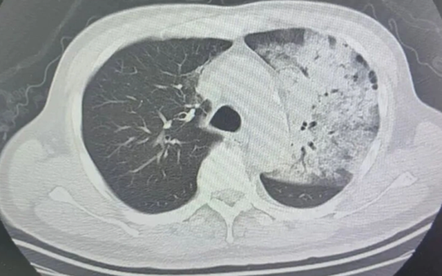 Người đàn ông sốt 40 độ C, phổi gần như 'trắng xóa", chỉ vài ngày đã suy đa tạng: Thủ phạm liên quan đến thói quen nhiều gia đình vẫn mắc