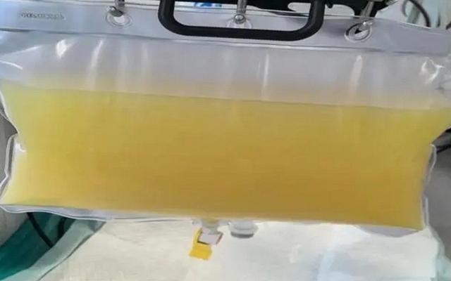 Rút ra 2 lít máu trắng đục như sữa từ cô bé 12 tuổi, bố mẹ oà khóc: "Tưởng cháu đau bụng vì ăn đồ không sạch"