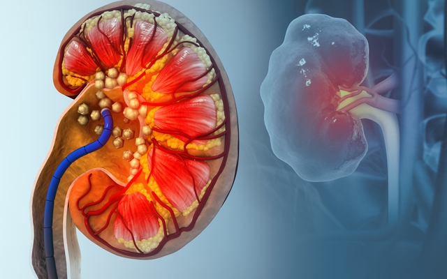 Thận chi chít sỏi chỉ vì uống 1 thứ để "tăng cường miễn dịch" trong suốt 6 tháng