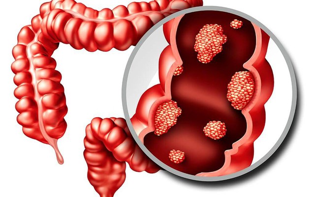 6 dấu hiệu cảnh báo đỏ của "căn bệnh ung thư đáng sợ": Có 1 cũng cần đi khám ngay!