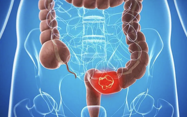 Người đàn ông 45 tuổi tử vong sau vài tháng phát hiện ung thư đại trực tràng: “Thủ phạm” là 3 ĐIỀU người Việt nào cũng hiểu nhưng LƯỜI LÀM