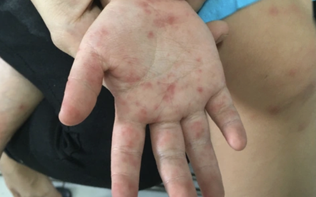 Làm gì để giảm nguy cơ tử vong và di chứng do bệnh tay chân miệng?