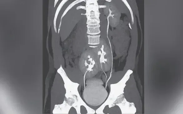 Đi khám nhiễm trùng tiết niệu, người đàn ông 31 tuổi phát hiện có 3 quả thận