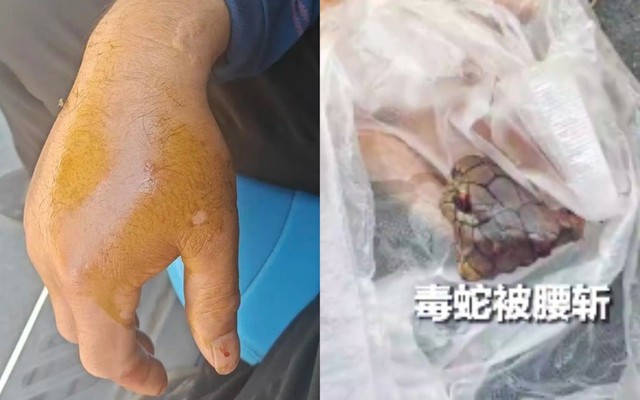 Bị rắn hổ mang chúa dài 2 mét cắn, người đàn ông chém đứt xác rắn rồi đến bệnh viện