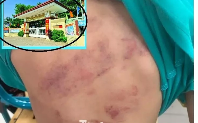 Học sinh lớp 1 bị bạn đánh hội đồng, phụ huynh bức xúc vì con phải chuyển lớp