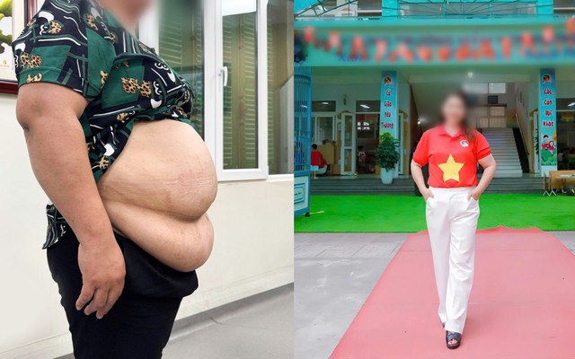 Bị từ chối hút mỡ vì quá béo, cô giáo mầm non 101kg “lột xác” theo cách không ngờ
