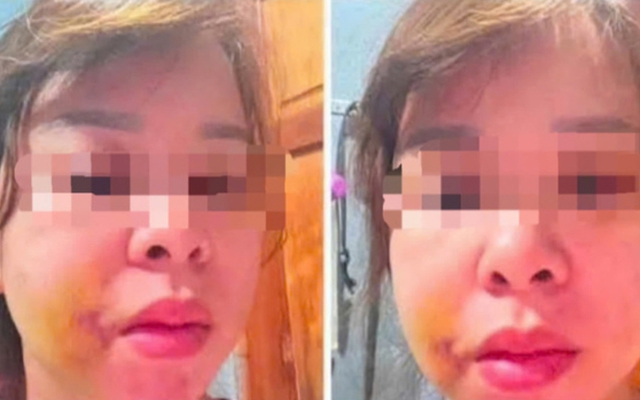 Người mẹ 3 con ở Đắk Lắk cầu cứu sau nhiều lần bị chồng hành hung