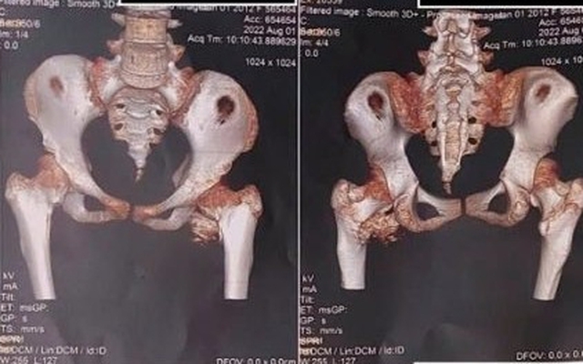Bé gái 12 tuổi mắc "hội chứng người hóa đá hiếm gặp", bố mẹ ngỡ ngàng khi bác sĩ nhắc tới cú ngã xe đạp 2 năm trước